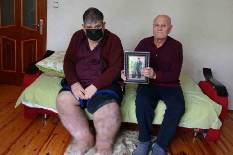 Sivrisinek ısırığı hayatını kararttı: 9 yıldır y&uuml;r&uuml;yemiyor