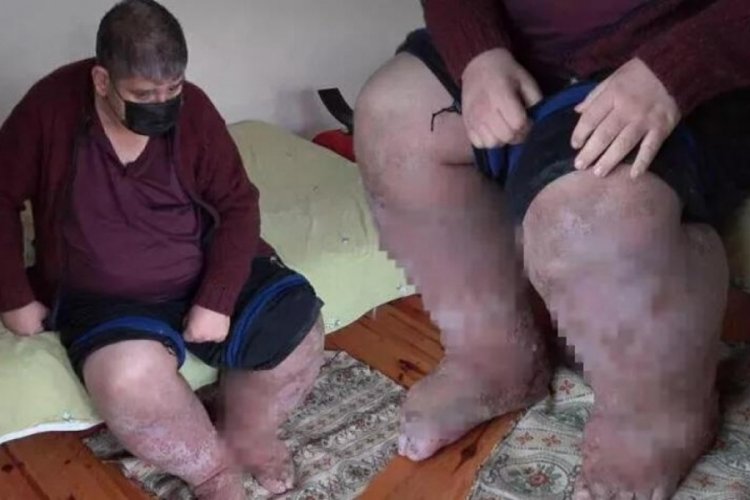 Denizli'de sivrisinek ısırığı hayatını karartmıştı! Acı haber geldi