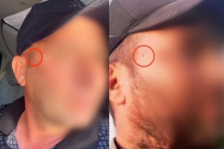 Yakalanmamak i&ccedil;in y&uuml;z&uuml;ndeki beni aldırdı