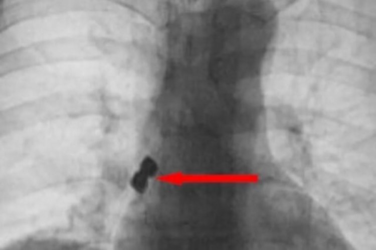 Diş doktorunda yanlışlıkla implantı yuttu!