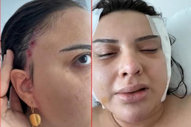 Badem g&ouml;z ameliyatı hayatını kararttı!
