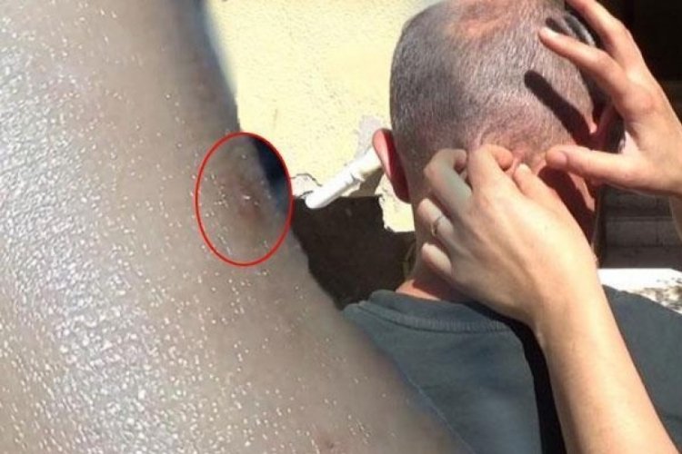 Hatay'da 5 kişilik ailede kurt&ccedil;uklar fışkırıyor! Doktorlar bile inanmadı