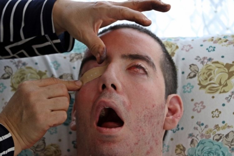 G&ouml;rme bozukluğuyla başladı, 10 yıldır g&ouml;zlerini kapatamıyor
