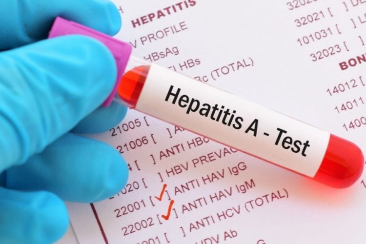 Hepatit A nedir? Hepatit A tedavisi nasıl yapılır? 