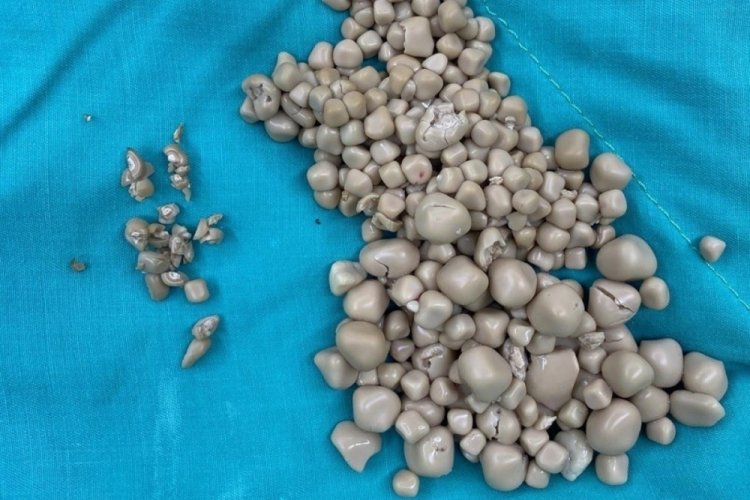 Tayvan'da şoke eden g&ouml;r&uuml;nt&uuml;! Kadının b&ouml;breklerinden 300 taş &ccedil;ıkarıldı