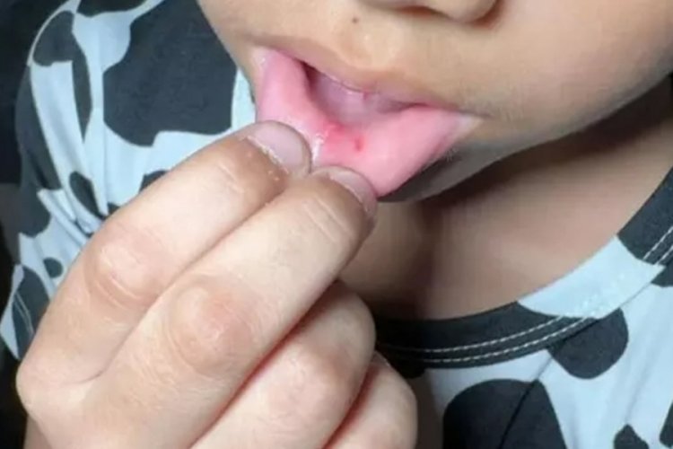 Sakızını yere atan &ouml;ğrencisinin dudaklarını &ccedil;engelli iğne ile deldi