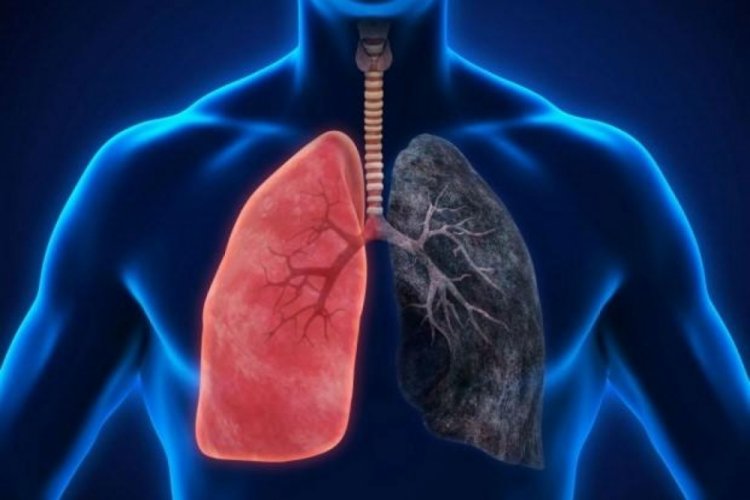 Akciğer kanseri nedir, nasıl oluşur?