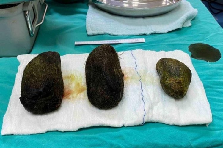 Midesinden 2 kilo kıl k&uuml;tlesi &ccedil;ıktı!