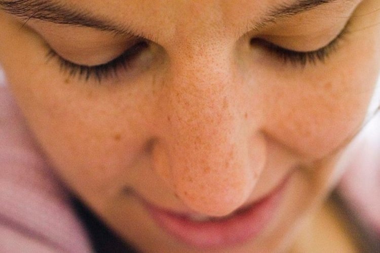 Cildinizde leke varsa doktora koşun: Kanser belirtisi olabilir