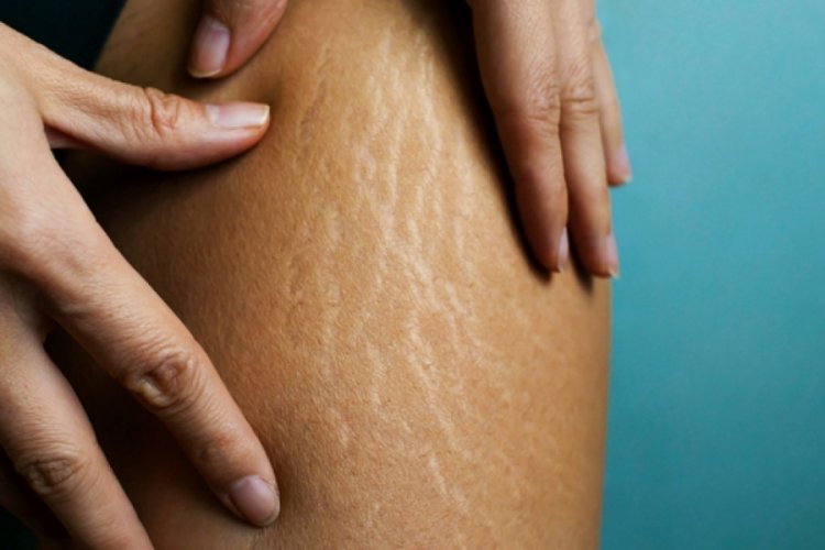 Vücutta çatlaklar neden olur?  Çatlak nasıl geçer? Çatlaklara ne iyi gelir? 