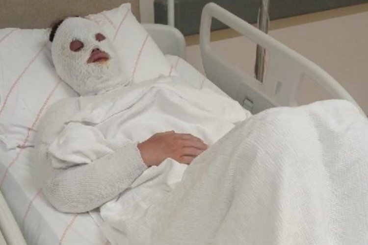 Eski nişanlısının y&uuml;z&uuml;ne kimyasal atan sanığa verilen 15 yıl ceza az bulundu!