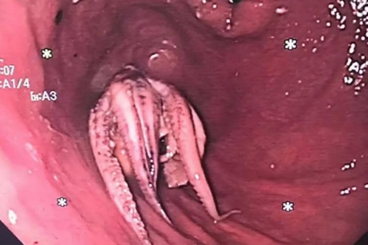 Yemek borusundan 5 cm b&uuml;y&uuml;kl&uuml;ğ&uuml;nde ahtapot &ccedil;ıktı!