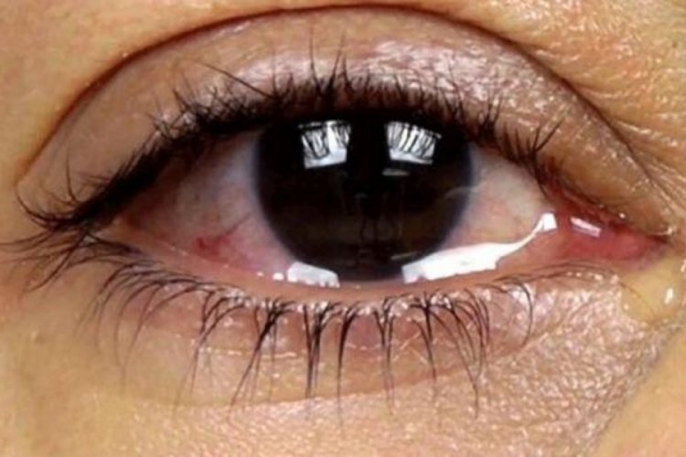 Göz sulanması nedir, neden olur? Göz yaşarması nasıl geçer?