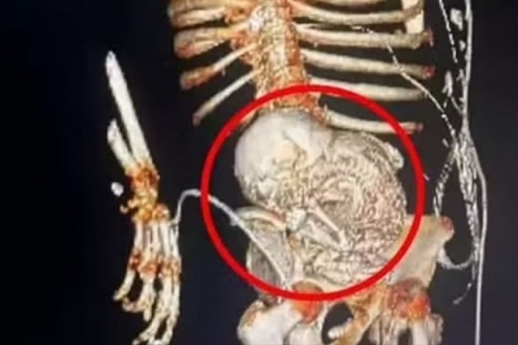 &Ouml;l&uuml; bebeğini 56 yıl boyunca karnında taşıdı