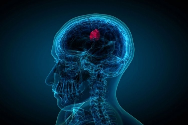 Beyinde lezyon nedir? Lezyon tümör müdür, kanser midir? Lezyon çeşitleri nelerdir?