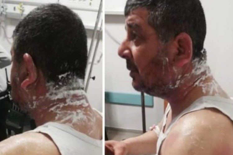 Hatay'da meclisi &uuml;yesi adayına asitli saldırı