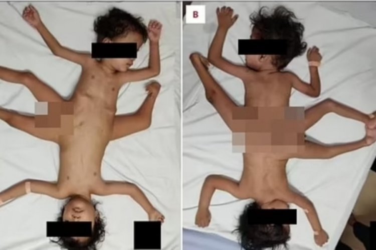 Pelvis b&ouml;lgesinden yapışık ikizler tıp tarihine ge&ccedil;ti