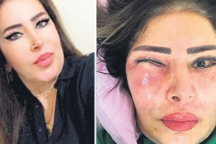 Y&uuml;z gerdirme ameliyatı hayatını kabusa &ccedil;evirdi!