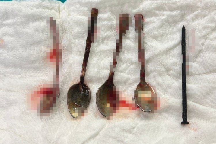 15 yaşındaki &ccedil;ocuğun midesinden &ccedil;ıkanlar şoke etti!