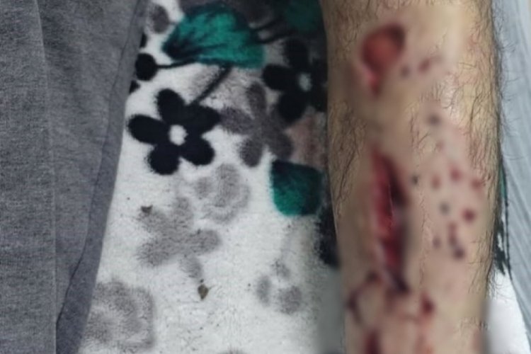 Eve giderken sokak köpeğinin saldırısına uğradı