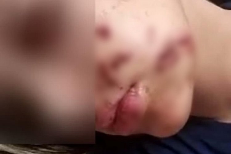 Yüzüne maytap isabet eden genç kız yaralandı