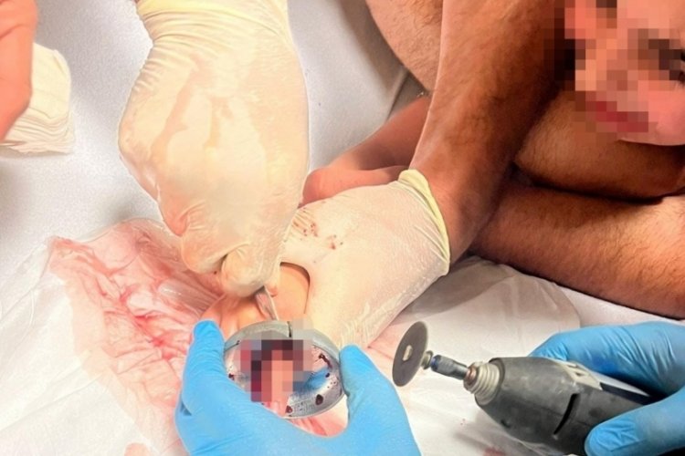 Bursa'da çocuğun parmağı çeşme aynasına sıkıştı