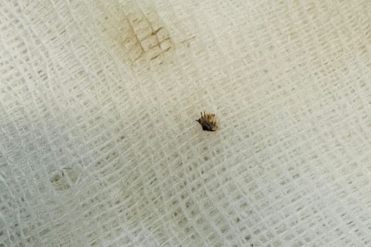 Halsizlik nedeniyle hastaneye gitti: Karnına yapışan kene bulundu