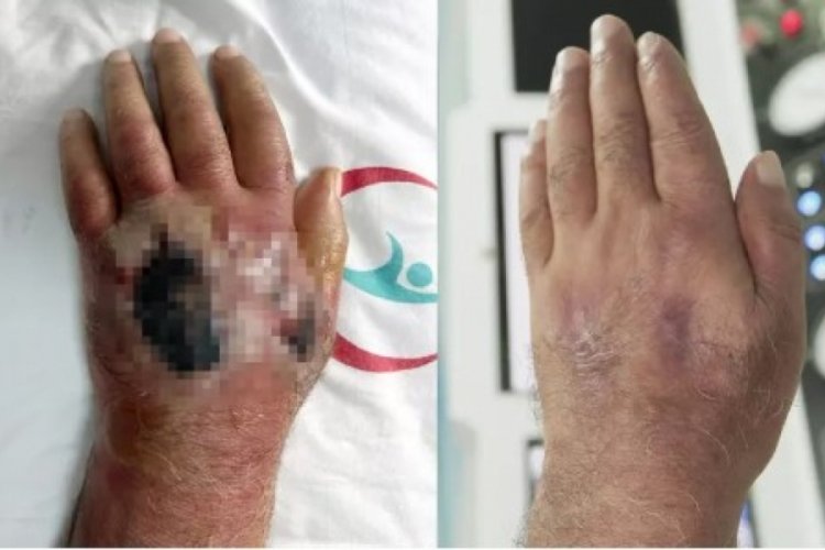 Bu bir insan ısırığı! Sakat kalmaktan son anda kurtarıldı