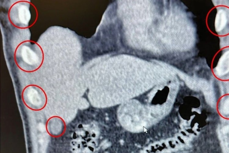 Midelerinden 136 kapsül uyuşturucu çıktı 