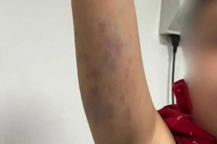 Okulda otizmli &ccedil;ocuğa şiddet skandalı! G&uuml;ndemi sarsan olayla ilgili flaş gelişme