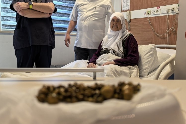 Bursa'da 77 yaşındaki kadının safra kesesinden 213 tane taş &ccedil;ıkarıldı
