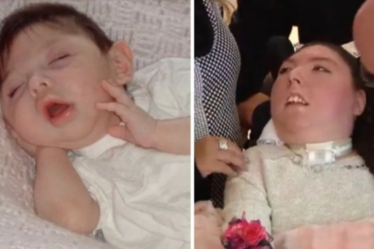 Beyni olmadan d&uuml;nyaya gelmişti: Doktorlar '5 yıl bile yaşamaz' dedi, şimdi 20 yaşında