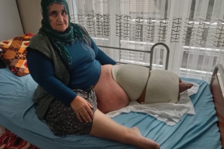 Fil hastalığı bacağını 100 kilo yaptı, tedavisinin devamı i&ccedil;in destek bekliyor