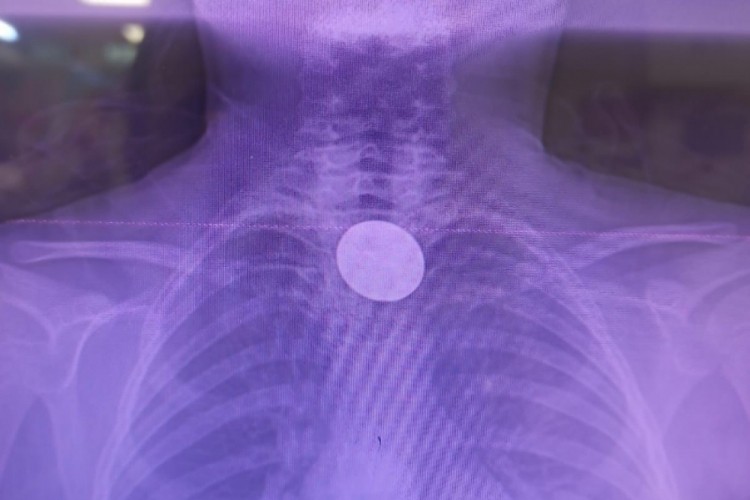 Madeni para yutan &ccedil;ocuk, doktor m&uuml;dahalesiyle kurtuldu!
