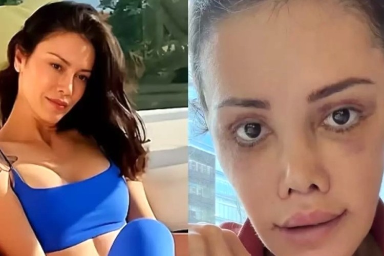 Yüz nakli yaptıran Didem Ceran'ın son hali: Harika gözüküyorum