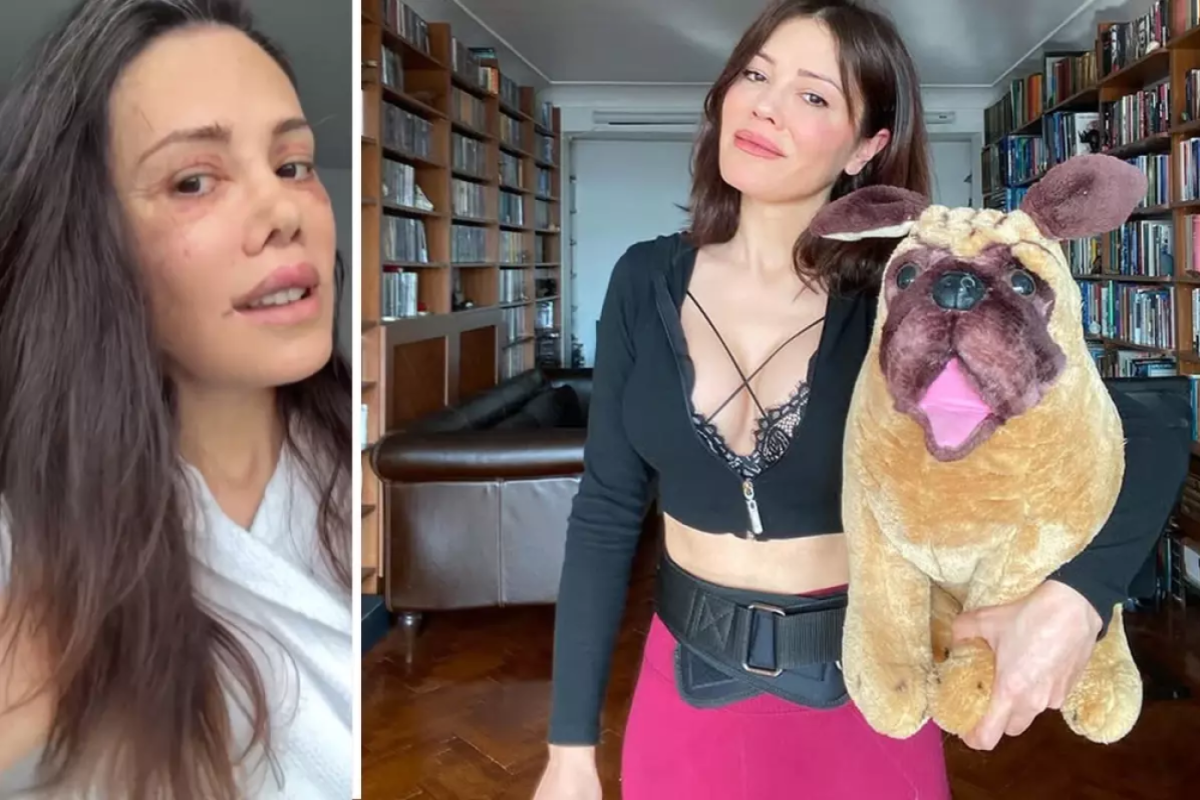 Didem Ceran, yüz estetiği sonrası 19 gündür banyo yapmadığını açıkladı