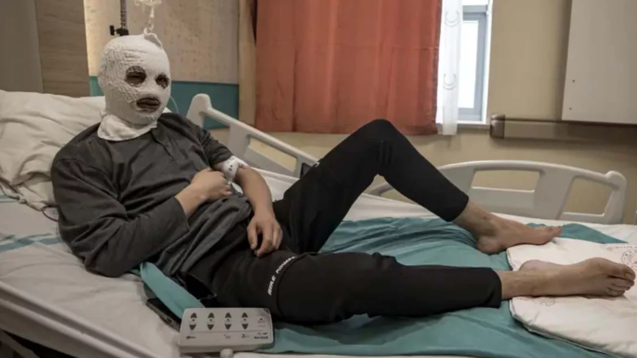 Çakmak gazı tüpü patladı: 19 yaşındaki gencin yüzü ve göğsü yandı 