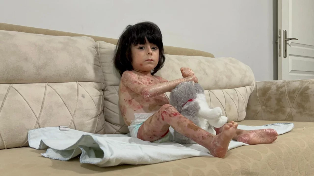 Bursa'da 4 yaşındaki 'Kelebek Çocuk' hayata tutunmaya ç...