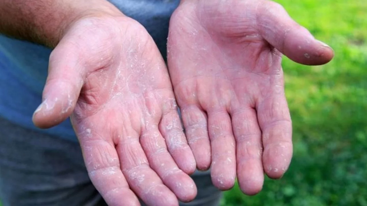 Bilim insanlarından çığır açan keşif: Egzamanın nedeni ...