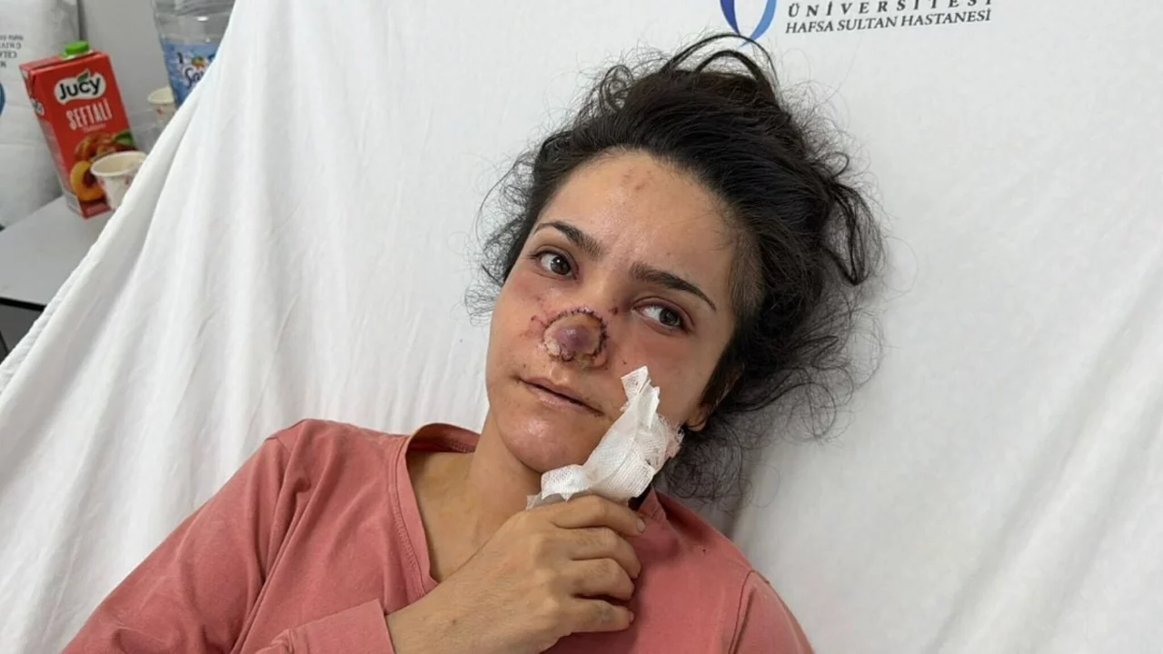 Eşi tarafından burnu ısırılıp koparılan kadın: "Canımın acıyla balkondan atlamayı bile düşündüm"