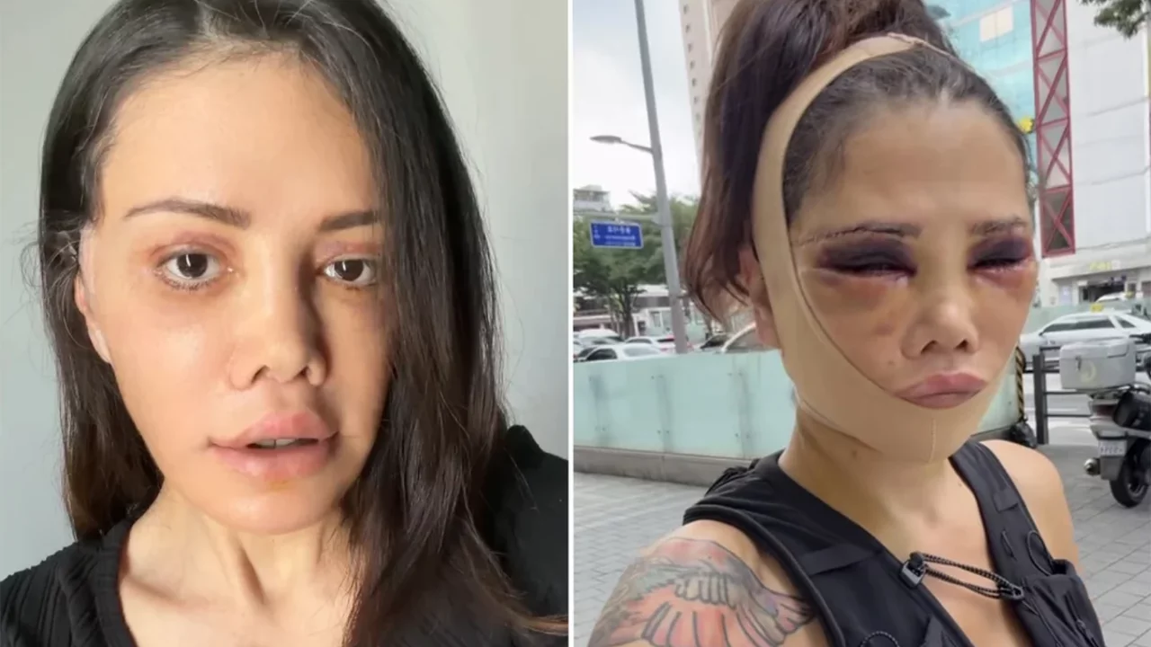 Didem Ceran g&ouml;zyaşları i&ccedil;inde konuştu! Revizyon ameliyatı sonrası yaptığı a&ccedil;ıklama g&uuml;ndem oldu