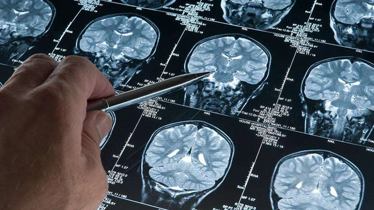 Derin uyku Alzheimer hastalığının ilerlemesini durduruyor 