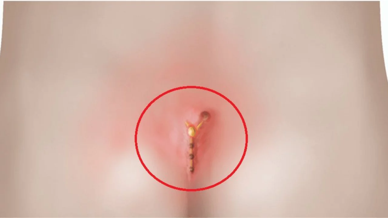 Kıl d&ouml;nmesi nasıl anlaşılır, nasıl ge&ccedil;er? Belirtileri ve yapılması gerekenler