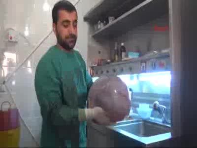 Suriyeli 79 yaşındaki kadının karnından 12 kiloluk kist çıktı