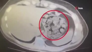 Yabancı uyruklu kuryenin midesinden yarım kilo uyuşturucu çıktı!