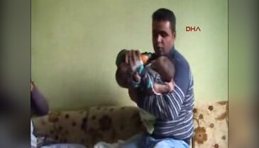 Siyam ikizleri ayrılmayı bekliyor