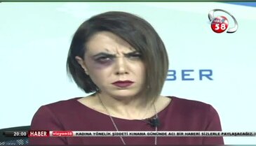 Canlı yayına morarmış gözle çıktı