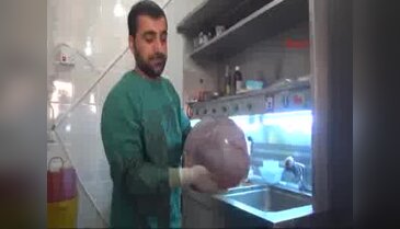 Suriyeli 79 yaşındaki kadının karnından 12 kiloluk kist çıktı