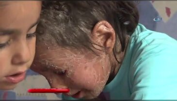 Bursa'da balık derisi hastalığına yakalanan Azra yardım bekliyor