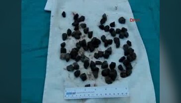 Midesinden yarım kilo ağırlığında 82 parça taş çıktı